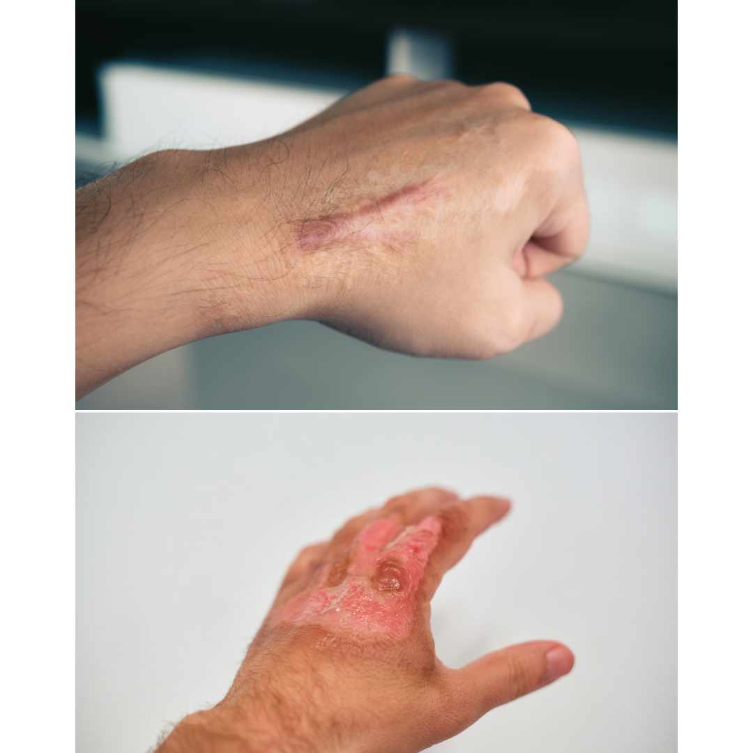 SCARSIL GEL – The Best Silicone Scar Gel for Old & New Scars
