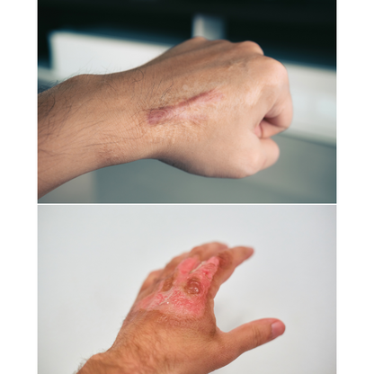 SCARSIL GEL – The Best Silicone Scar Gel for Old & New Scars
